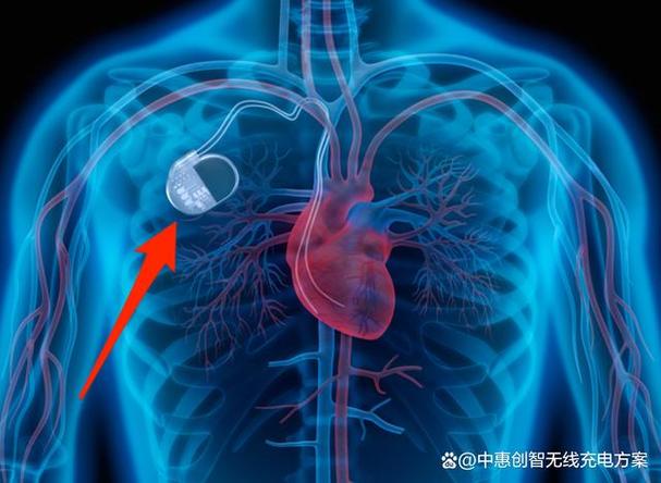 体内植入医疗电子产品无线充电方案的应用